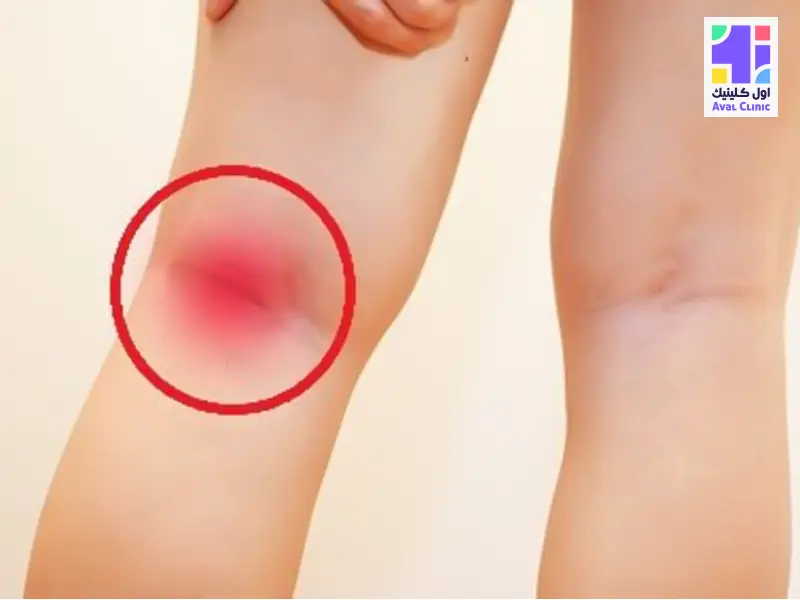 علت درد پشت زانو چیست؟