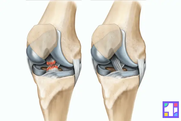آسیب رباط ای اصلی زانو می تواند منجر به بی ثباتی و درد پشت زانو شود.