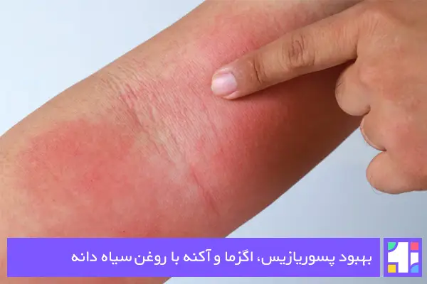 روغن سیاه دانه دارای اثرات ضدالتهابی و ضدمیکروبی است که در درمان آکنه و انواع مشکلات پوستی کاربرد دارد.