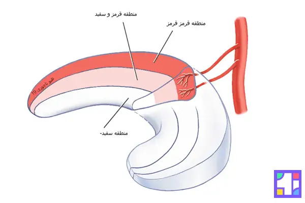 پارگی مینیسک زانو اگر در خارجی ترین ناحیه که شامل سلولهای خونی است اتفاق بیفتد بهبود می یابد. 