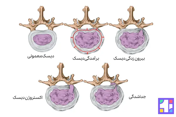 مراحل پیشرفت دیسک کمر