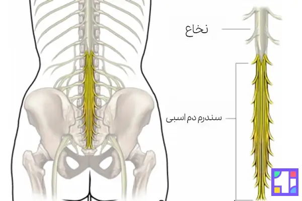 سندروم دم عصبی یکی از عوارض دیسک کمر خطرناک است.