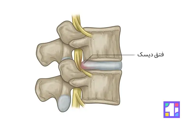 درد دیسک کمر ناشی از برآمدگی، بیرون زدگی و یا پارگی دیسک بین مهره ای است.