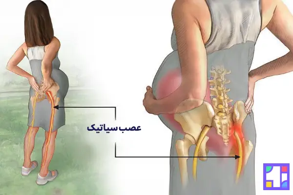 تغییرات فیزیولوژیکی و هورمونی بدن مادر، افزایش وزن و تغییر مرکز ثقل به‌دلیل بزرگ شدن شکم به عصب سیاتیک فشار وارد می کند.