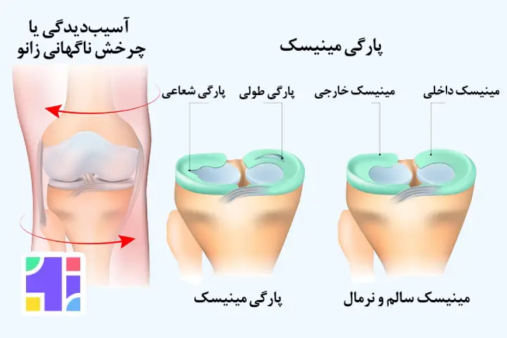 آسیب مینیسک داخلی و خارجی