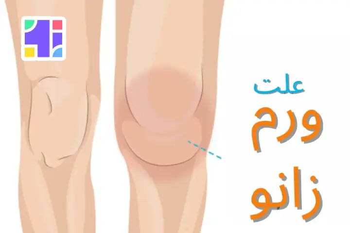بررسی علت ورم زانو