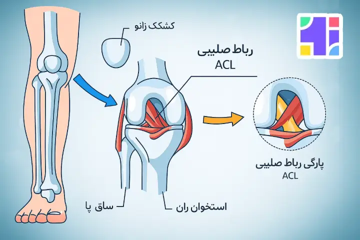 پارگی رباط صلیبی قدامی