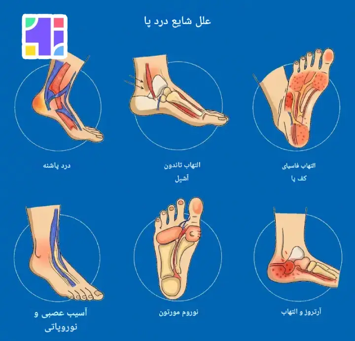 درد کف پا نشانه بیماری