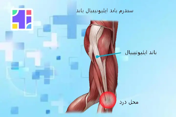 سندرم باند ایلیوتیبیال زانو