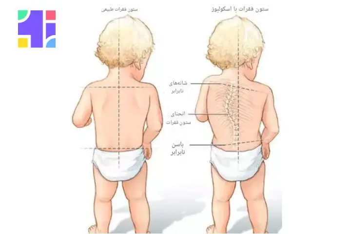 انحراف ستون فقرات در کودکان