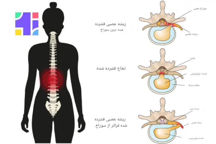 تنگی کانال نخاعی