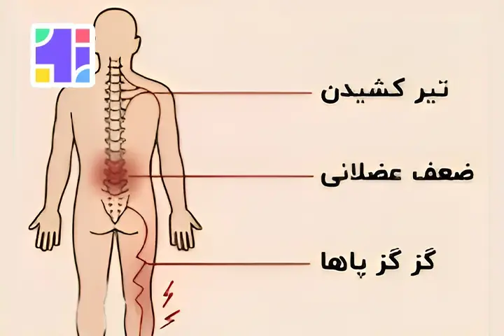 علائم التهاب دیسک کمر